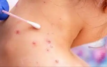 منظمة الصحة العالمية تعلن ‎جدري القردة حالة طوارئ صحية عالمية