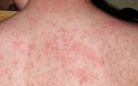 وزارة الصحة توضح بخصوص ارتفاع عدد حالات الحصبة (بوحمرون) في جهة سوس ماسة