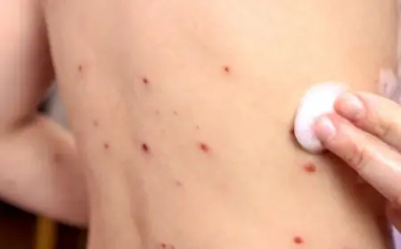 تحذيرات حقوقية من انتشار داء الحصبة ”بوحمرون”