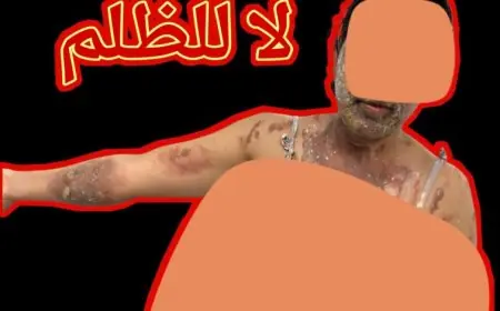 الرابطة المغربية للمواطنة وحقوق الإنسان تدق ناقوس الخطر بعد تعرض عاملة منزلية بالقنيطرة لحروق بليغة