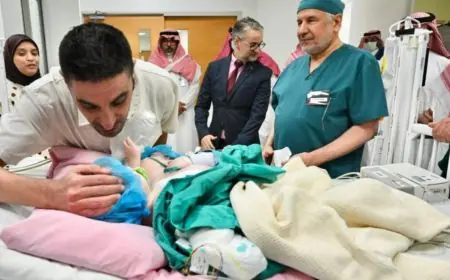فريق طبي سعودي ينجح في فصل توأم مغربي